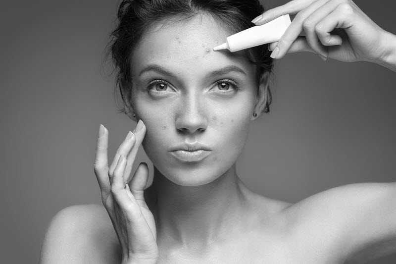 treating hormonal acne